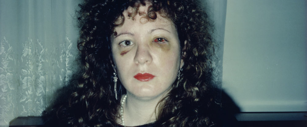 Nan after being battered, 1984